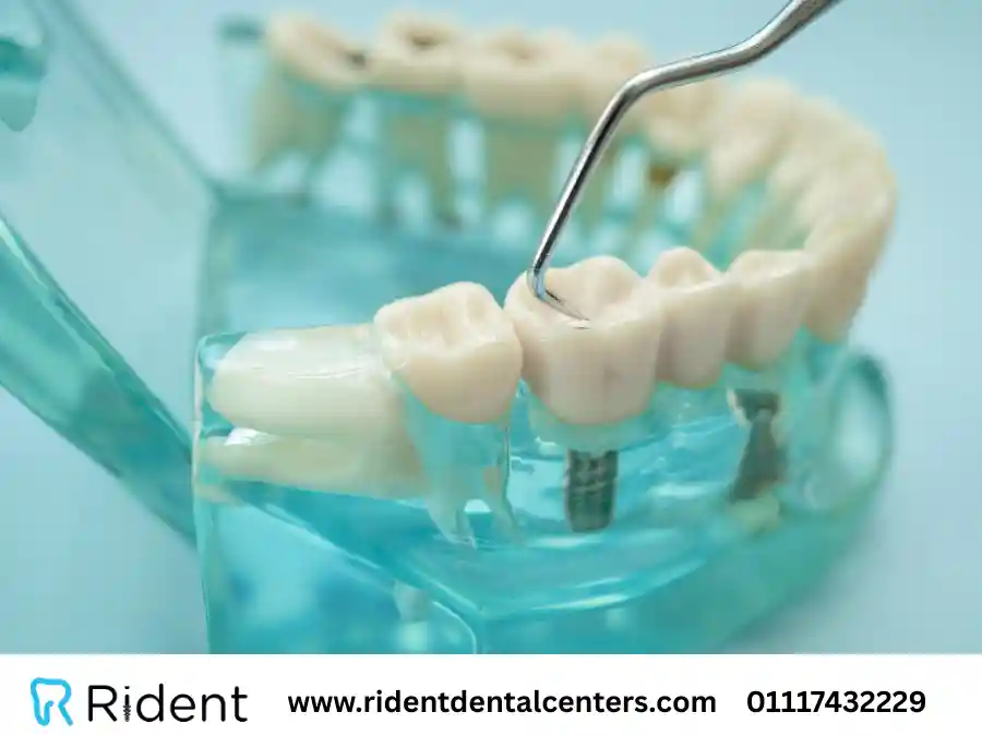 إجابات تساؤلات شائعة في زراعة الأسنان